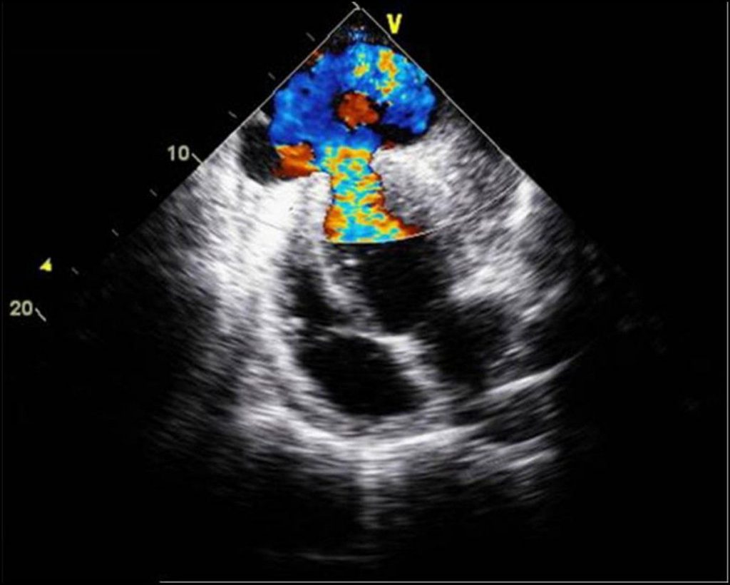 Echocardiography mushroom cloud