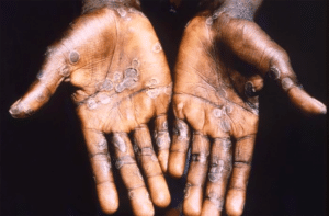 The hands of a monkeypox patient.
