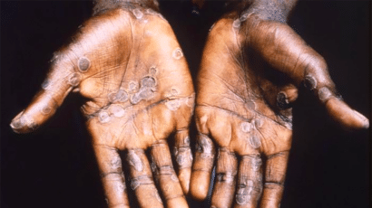 The hands of a monkeypox patient.