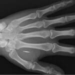 x-ray of hand with RFID chip implanted
