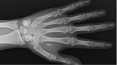 x-ray of hand with RFID chip implanted