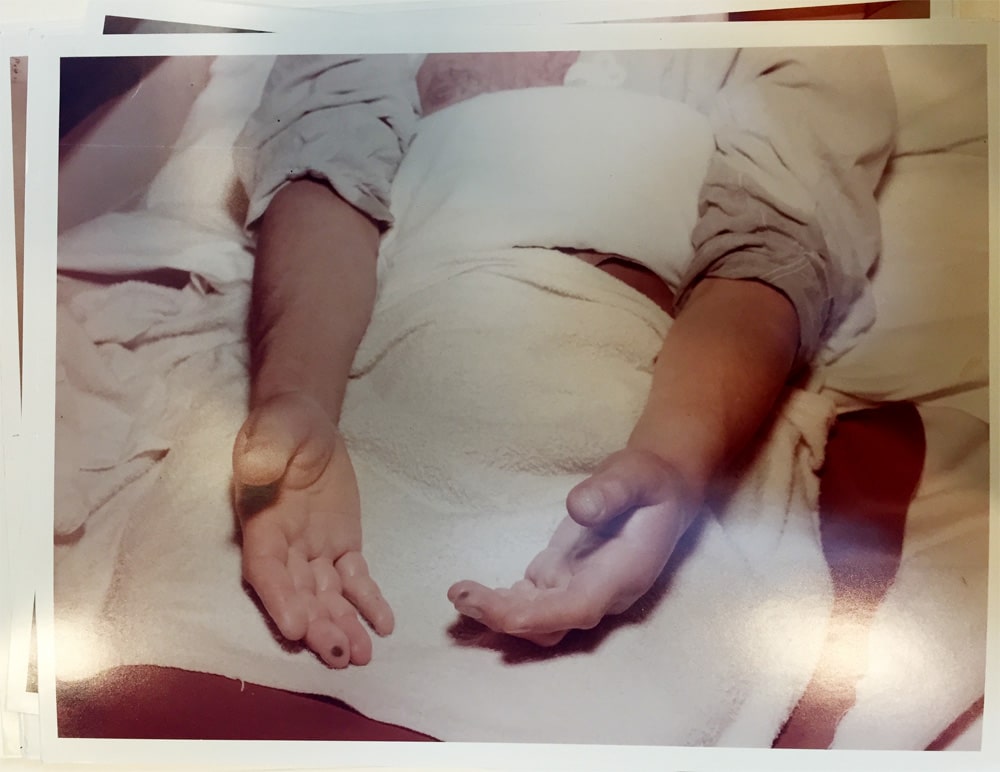 The hands of Louis Slotin, shortly after admission to the Los Alamos hospital. (Los Alamos National Laboratory, via <a href="https://blog.nuclearsecrecy.com/2016/05/23/the-blue-flash/">Alex Wellerstein</a> / New York Public Library)
